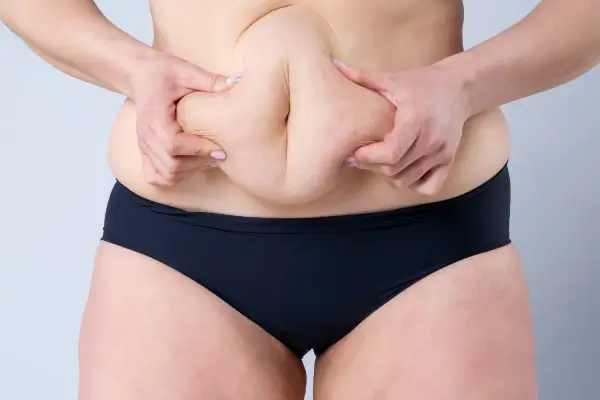 Abdominoplastia de mujer agarrándose la piel del estomago