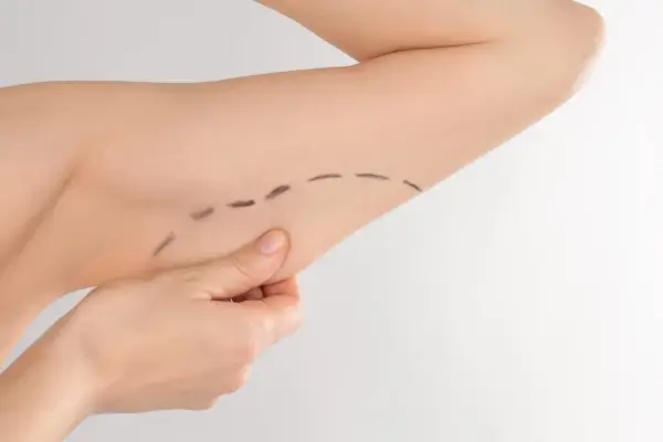 Braquioplastia brazo de mujer
