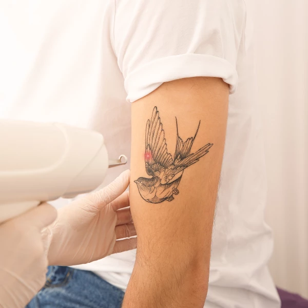 Eliminación de tatuajes en picosegundos