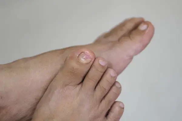 Onicomicosis 1 (1) quiropodia