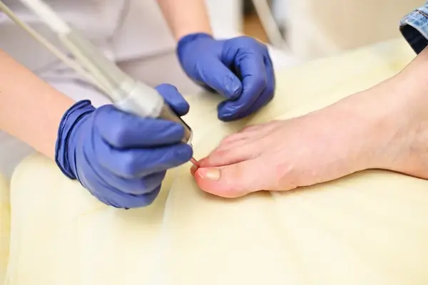 Onicomicosis 3 (1) quiropodia